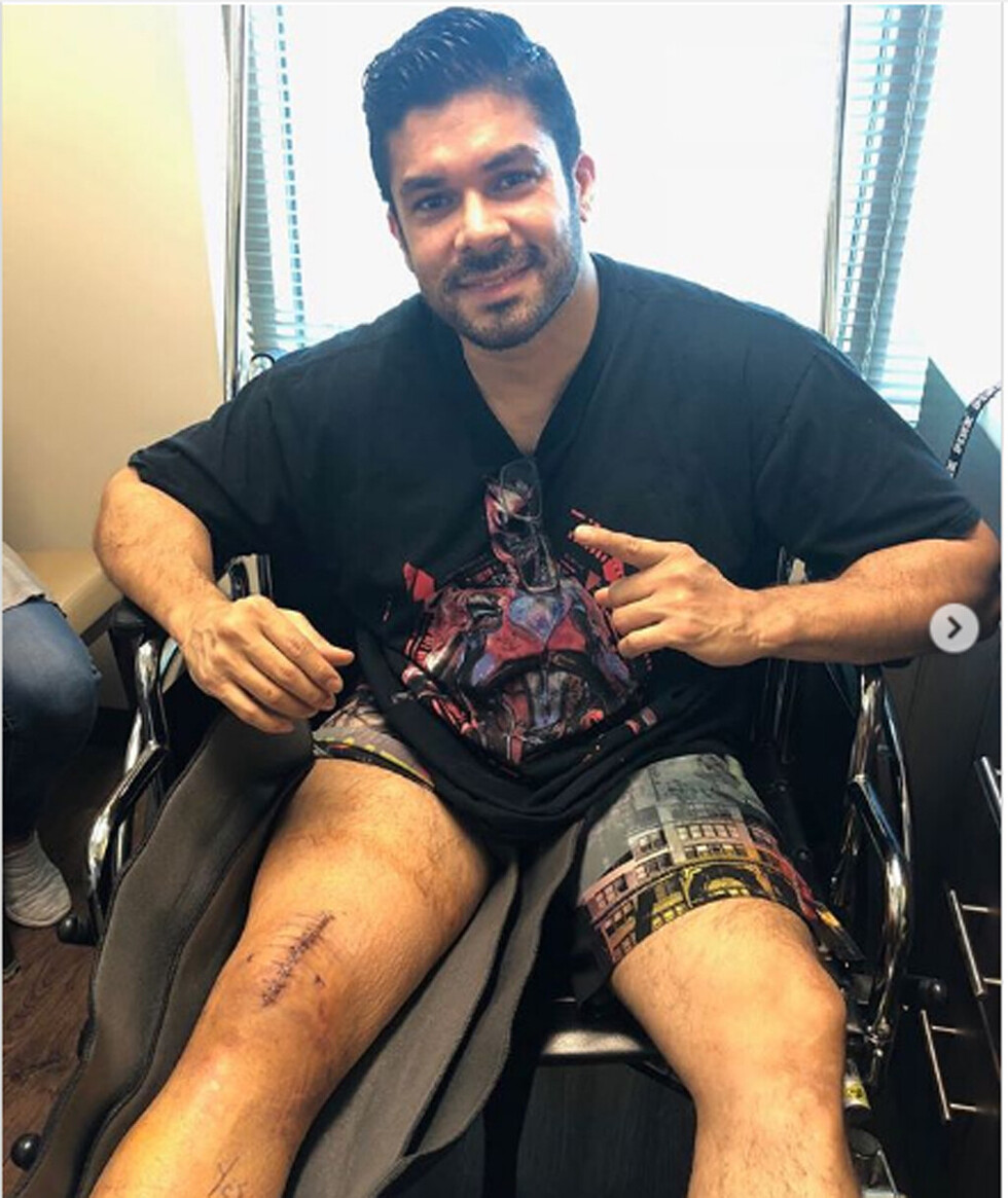 Jerry Rivera  mostró cicatriz de su rodilla