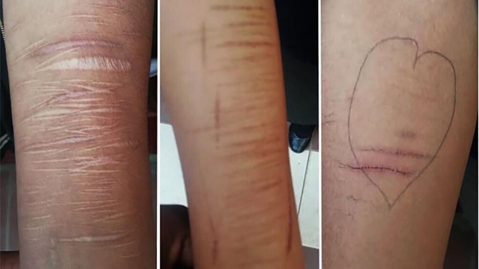 Descubren a 26 colegiales con cortes autoprovocados