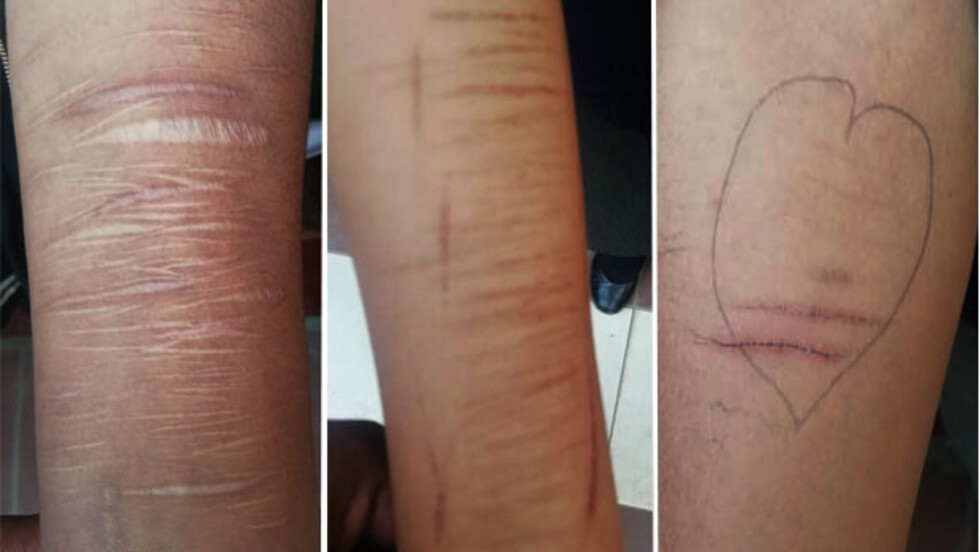 Hallan a 26 colegiales con cortes autoprovocados