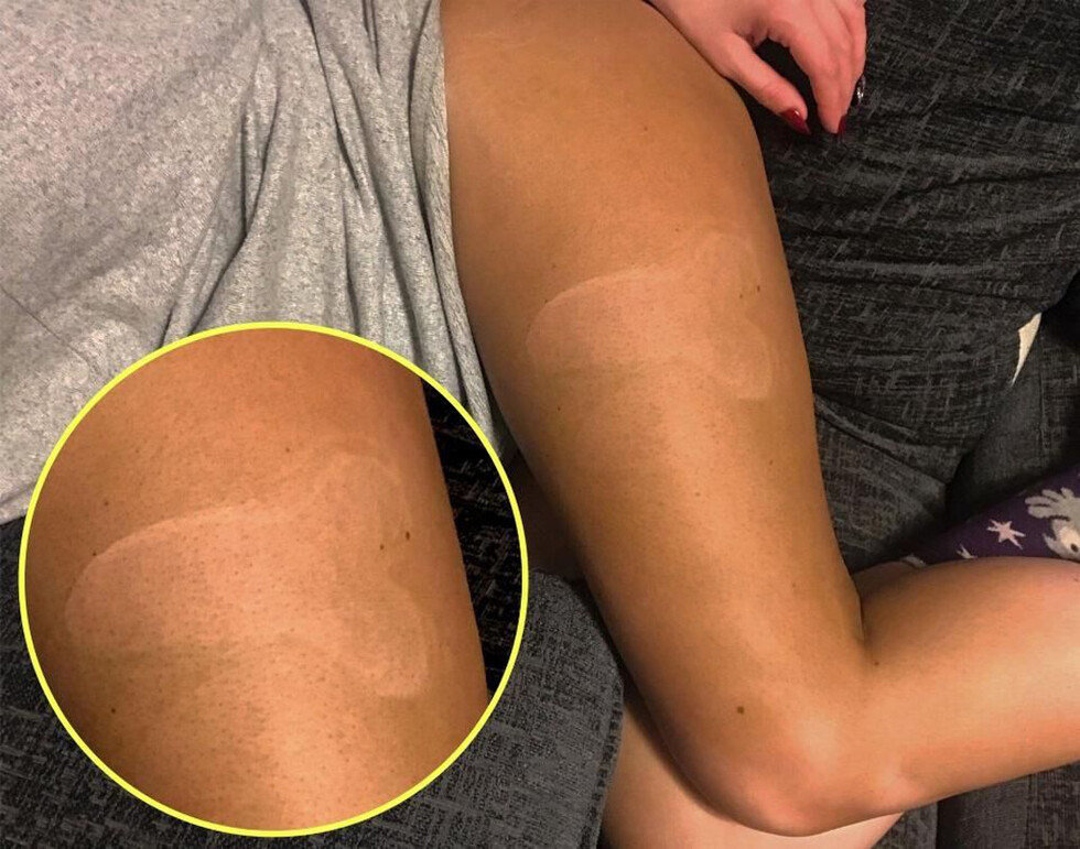 Durmió con novio y le quedó marca del pene