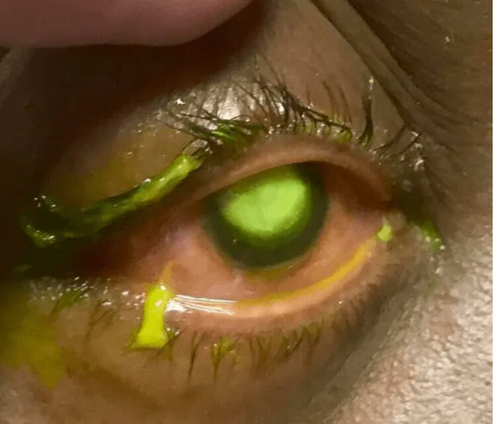 Sus lentes de contacto casi le dejan ciega