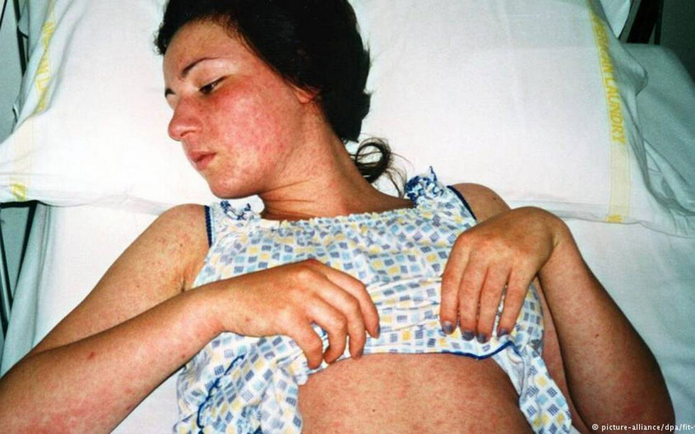 El resurgir del sarampión y la alerta en el mundo