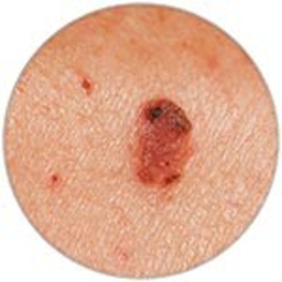 Los lunares peligrosos y el cáncer, tips para detectarlos