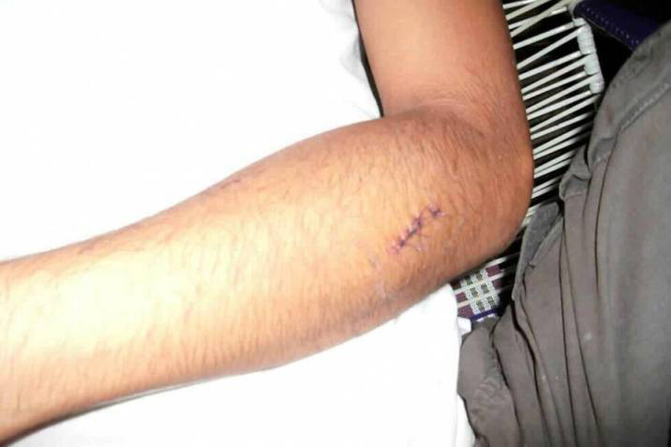 Apuñalan a “parroquiano”  en su brazo y en la nalga