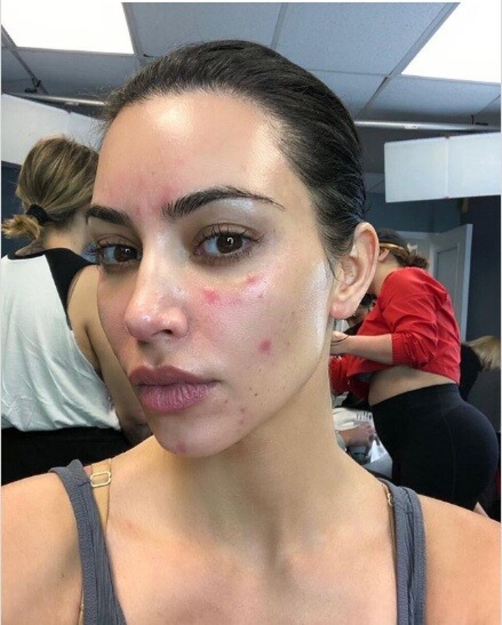Kim muestra su incurable enfermedad