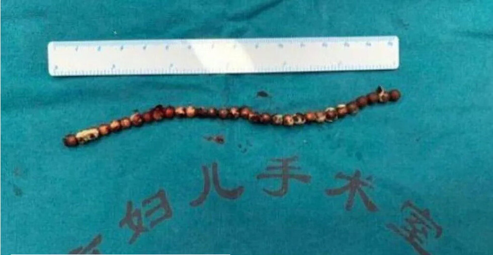 Un niño se metió 31 bolitas al pene