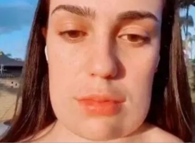 Se inyectó ácido y se le deformó la cara