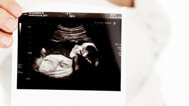 Una bebé nace con una frondosa cabellera que ya era visible a las 34 semanas de embarazo