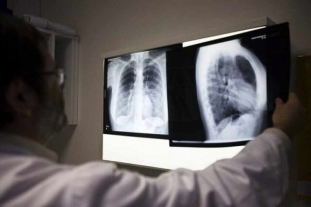 En 9 meses Tarija reportó 175 casos de tuberculosis