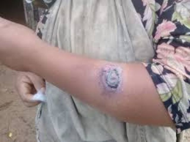 Entregan medicamentos para pacientes con leishmaniasis en el Tipnis
