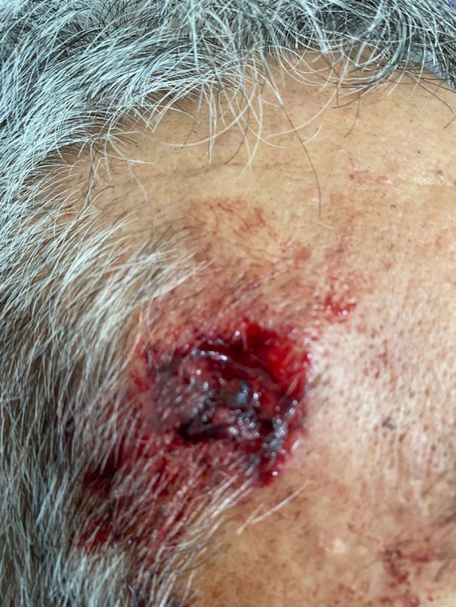 Seis personas resultaron heridas tras ataques de militantes del MAS en puntos de bloqueo