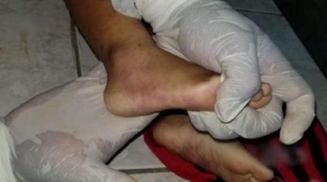 Infanticidio: Presumen que menor murió por sobredosis de insulina