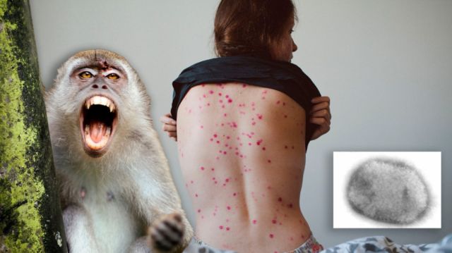 Salud: Viruela símica y las  razones para estar alertas