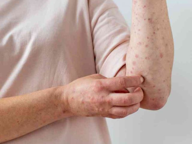 Más de 50.000 casos de viruela símica en el mundo