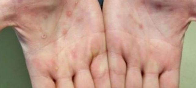 Salud reporta 97 casos activos de viruela símica en Bolivia