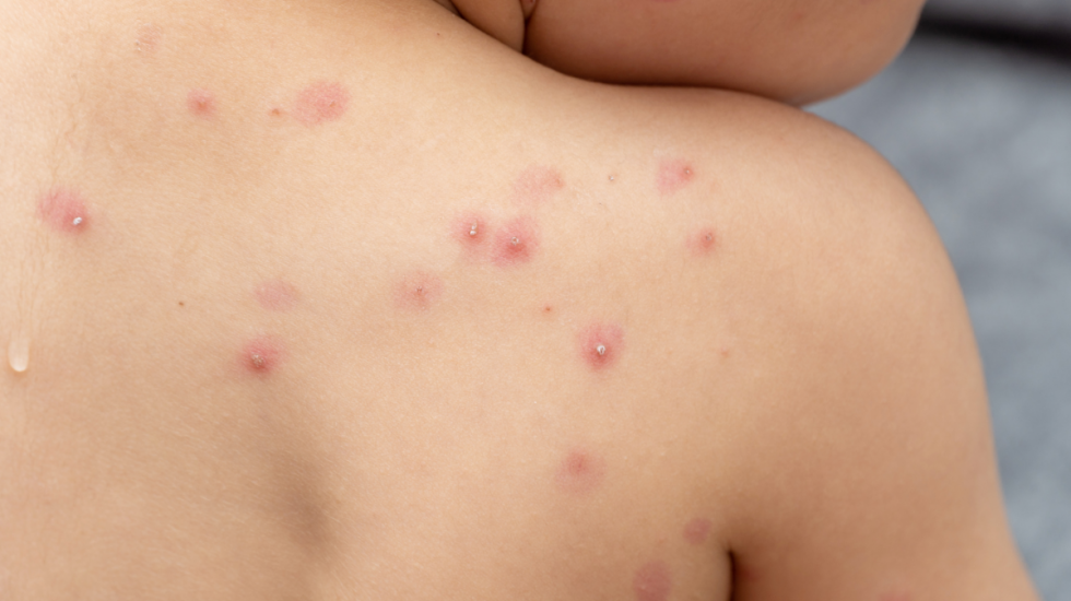 El Sedes descarta caso sospechoso de Mpox o viruela símica en Cochabamba