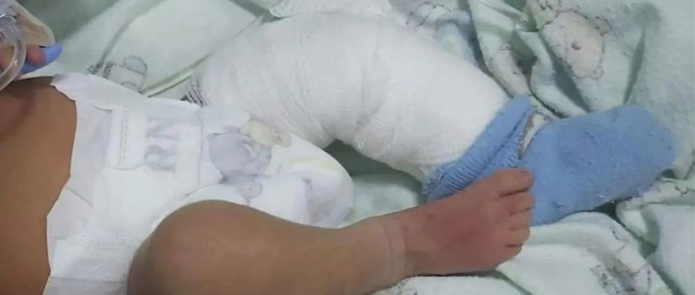 Bebé con quemaduras en hospital: Fiscalía investiga y pide lista del personal que lo atendió