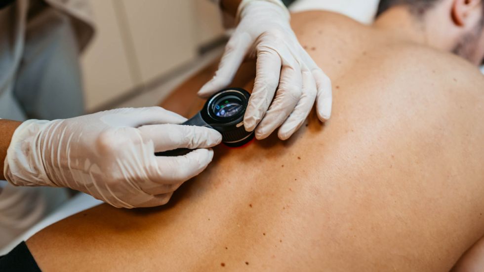 Detectan preocupante incremento de cáncer de piel tras estudio a más de 500 pacientes