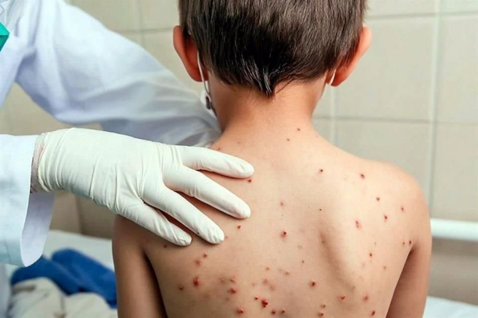 SEDES intensifica rastrillajes para identificar a menores no vacunados ante alerta por sarampión