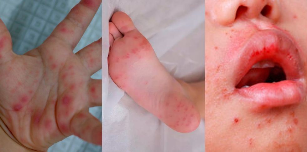 Tarija registra casos de síndrome mano-pie-boca, una enfermedad viral contagiosa